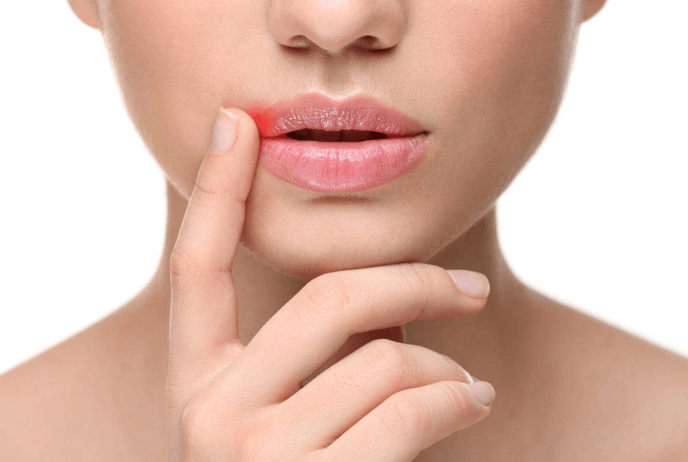 Медик перечислил средства, которые помогут избавиться от герпеса на губах