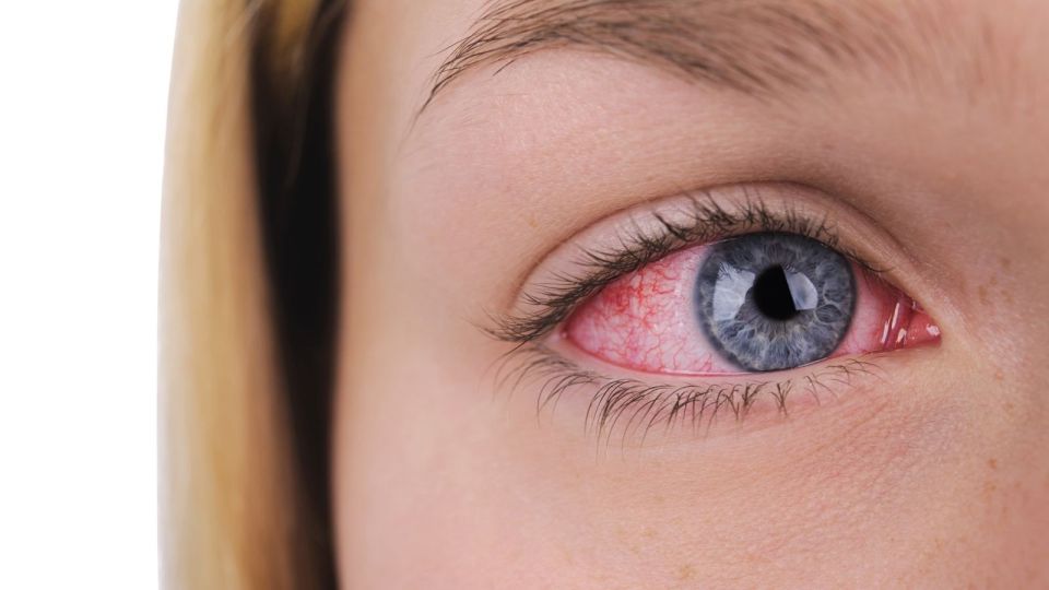 О причинах покраснения глаз и способах лечения рассказала офтальмолог