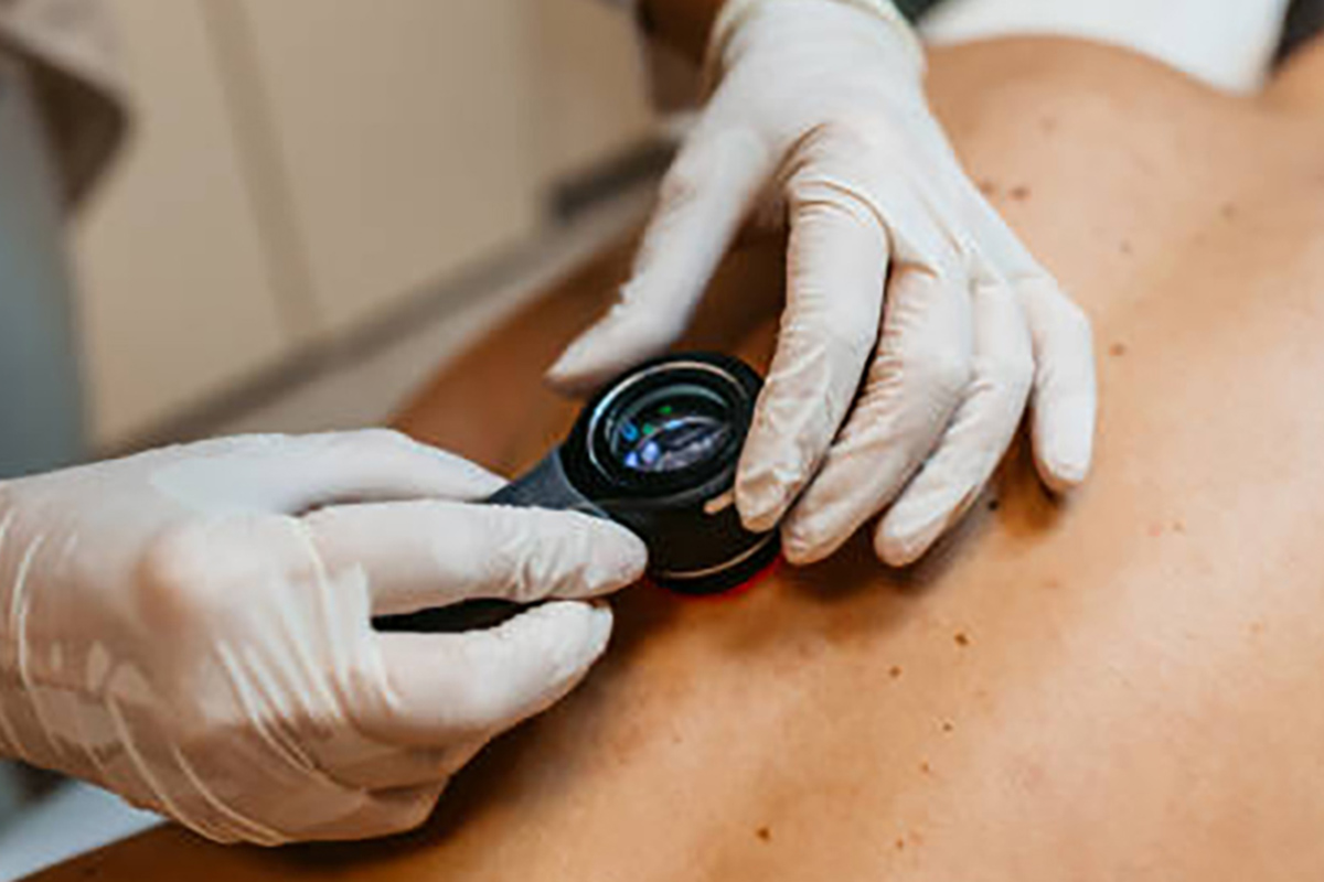 Как вовремя распознать опасную родинку: советы дерматолога