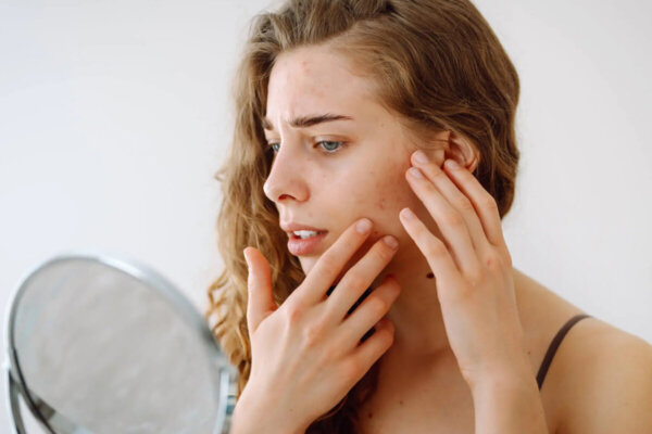 Локализация акне: роль возраста, типа кожи и возможные внутренние причины